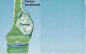 Pengobatan Kanker Tulang