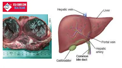 What Is Liver Hemangioma?