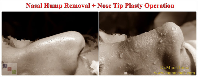 Nasal Hump Removal - Nasal Hump Reduction - Nasal Hump Removal Procedure Can Be Done Without Breaking The Nasal Bone! - In The Healing Time After The Nasal Hump Removal, It May Protrude Partially Over The Nose! - Nasal Hump Removal Alone is Not Suitable For Each Patient! -  Nasal Hump Removed Excessively Your Nose May Look Larger and Wider Than Before From The Front View - Nasal Hump Removal In Patients With Twisted Nose and Curved Nose Deformity - The Upper Part of The Nose Bone is Usually Removed During The Procedure of Nasal Hump Reduction - The Result After Healing From Nasal Hump Removal and Pre-operative Computer Nose Aesthetics Animation Can Be Different! - The Nose Filler Procedure Does Not Remove The Nose Belt! - The Nose Filler Procedure Does Not Remove The Nose Belt! - How Long is The Recovery Time After The Nose Belt Surgery and Nose Aesthetic Surgery? - Recovery Process of Nasal Rasping - Nasal Rasping Age Limit - Nasal Hump Removal - Nasal Hump Reduction in Istanbul - Nasal Hump Removal in Istanbul - Nasal Hump Removal in Turkey - Nasal Hump Rasping in Istanbul - Dorsal Hump Removal in Istanbul - Nasal Hump Rhinoplasty in Istanbul - Nasal Hump Reduction in Istanbul - Rhinoplasty Without Bone Breaking in Istanbul - Nose job Without Breaking Bone - Removal of The Nasal Hump in Istanbul - Nasal Aesthetic Surgery Without Breaking The Bone in Istanbul - Rhinoplasty Without Breaking Nose Bone in Turkey - Rhinoplasty in Istanbul