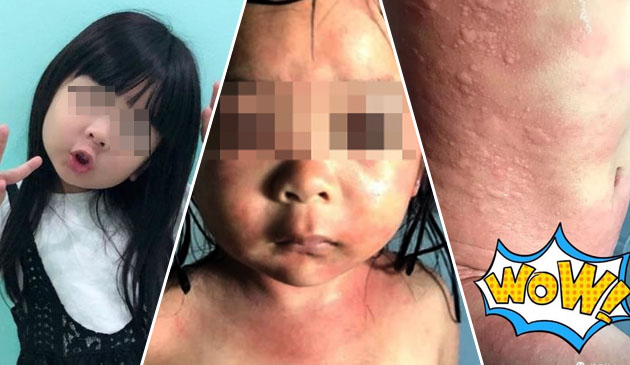 Kulit anak kemerahan & rasa terbakar selepas mandi di kolam renang awam yang baru dibersihkan