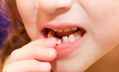 Răng sữa lung lay bao lâu thì nhổ?