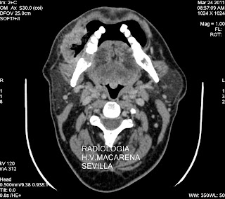 Carcinoma de encía