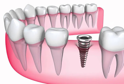 Quy trình cấy ghép implant bạn nên biết 2