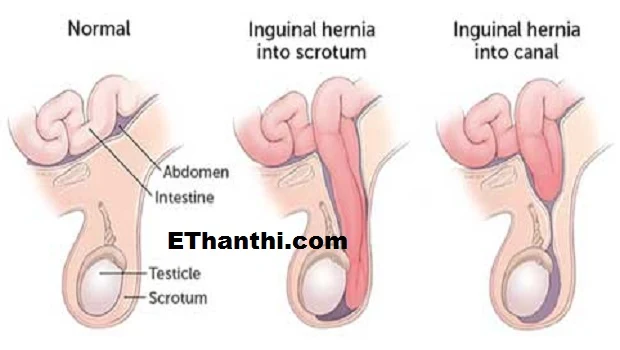 குடல் இறக்கத்துக்கான சிகிச்சை முறைகள் என்ன? #Treatmentofhernia