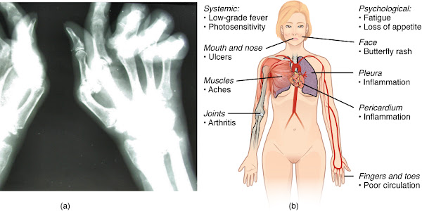  Arthritis : What is Arthritis  Symptoms - Causes - and Treatment ?