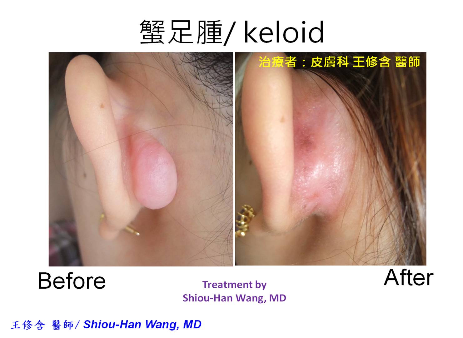皮膚科王修含醫師 蟹足腫 肥厚性疤痕 疤痕治療方法 皮膚科王修含醫師 蟹足腫 肥厚性疤痕 疤痕治療方法