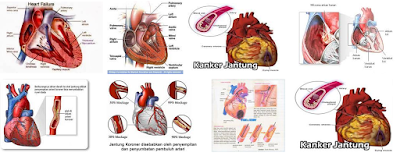 Obat Kanker Jantung Tradisional