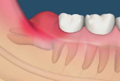 Trường hợp răng khôn mọc lệch 90 độ nên nhổ không?