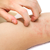 Know How To Treat Mild Eczema