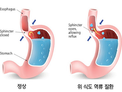 역류성 식도염 이미지