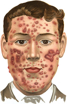 Cure for Cystic Acne