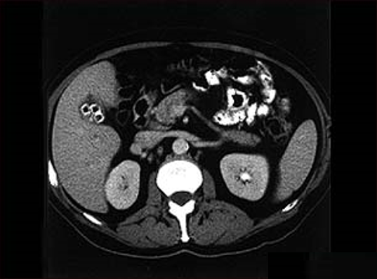 Computerized tomography, CT-Scan abdomen atas menunjukkan batu empedu multiple, kolelitiasis, potongan transversal, sagital, coronal, oblique, oblik, hiperekoik, hipoekoik, radiologi, rumah sakit, puskesmas, bpjs, jkn-kis, pencitraan imaging, hepar, vertebra