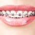 Niềng răng có khắc phục hàm hô không?