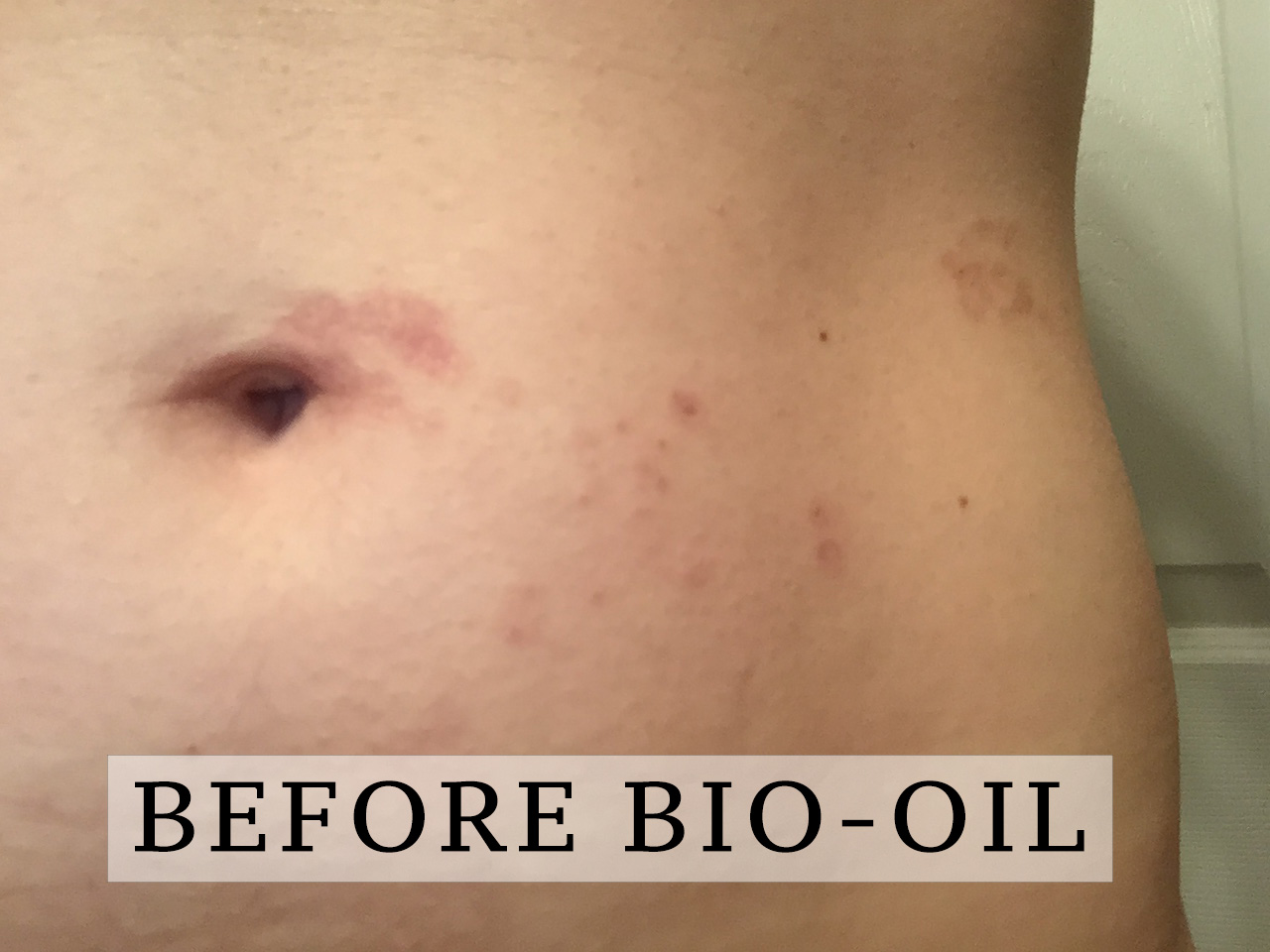 Beauty: Bio-Oil (before and after scars) | Orane Boucher