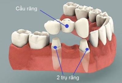 Các loại răng sứ phổ biến trong nha khoa