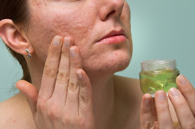  Natural Remedies To Eliminate Acne Marks Completely From Your Body