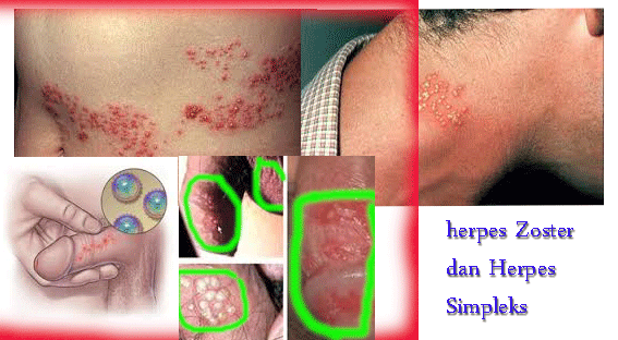 Pengobatan Penyakit Herpes