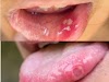 Get cure in one day mouth ulcer home remedies | mouth ulcer gel