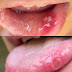 Get cure in one day mouth ulcer home remedies | mouth ulcer gel