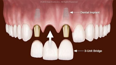 Cầu răng toàn sứ tồn tại bao lâu?