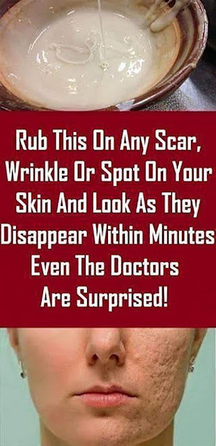 Rub This On Any Scar, Wrinkle Or Spot On Your Skin And Look As They Disappear Within Minutes! Even The Doctors Are Surprised!