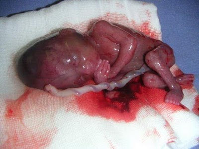 unborn baby - stop abortion