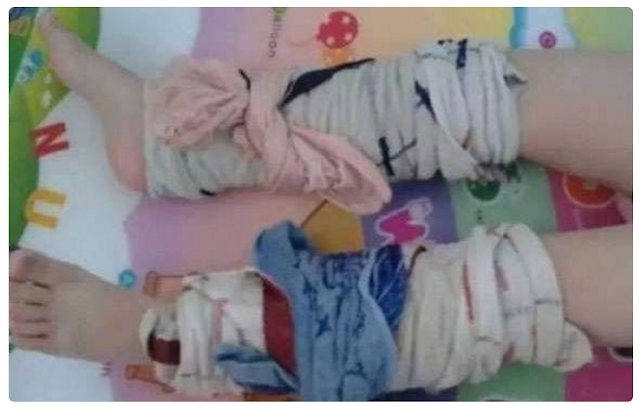 "Kompres Kaki" Cara Sederhana Namun Ampuh untuk Redakan Demam Anak