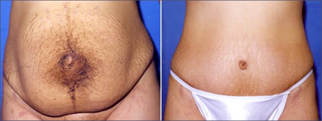 tummy tuck scars. Tummy Tuck Scars. otto