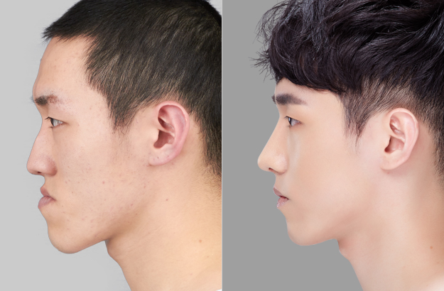 짱이뻐! - Before and After Photos Korean Plastic Surgery for Men