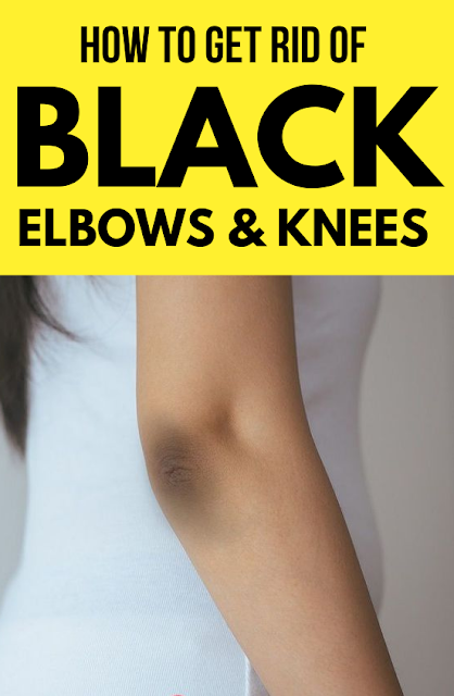 14 Home Remedies To Get Rid Of Black Knees And Elbow