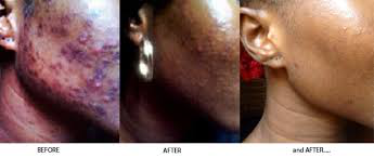  Lagos big girl reveals how black spot & acne made her lose 3 rich suitors & how she got rid of it in 27 days!