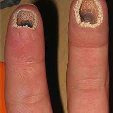 Ernyassmien: siapa ada penyakit trypophobia?