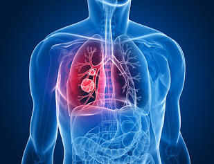 Mesothelioma Lung Cancer