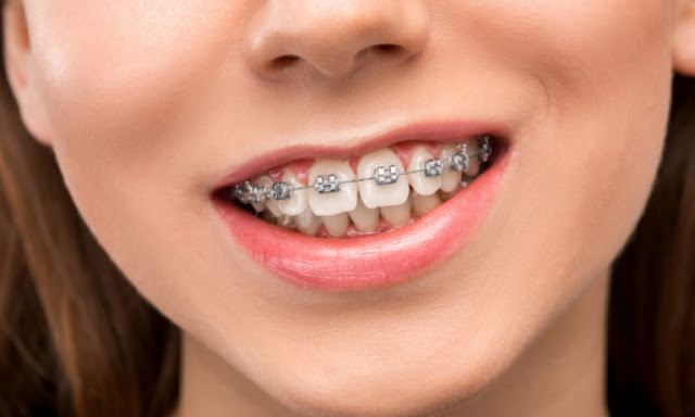 Fix bite issues by orthodontic braces