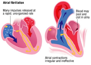Abnormal Heart Rhythms, Arrhythmias, Atrial Fibrillation
