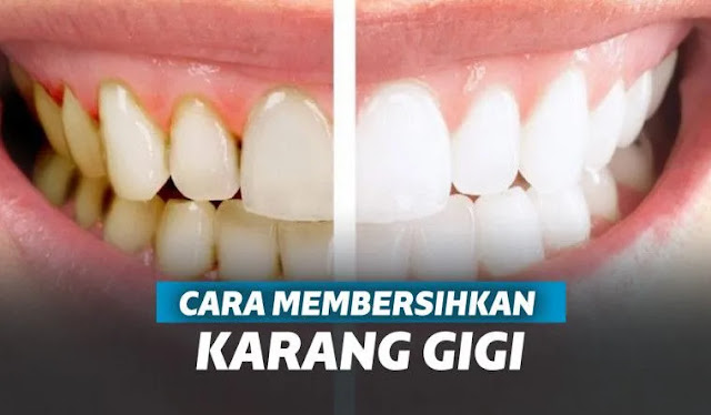 Karang gigi tak hanya mengurangi rasa percaya diri. Dari sisi medis, karang gigi juga menjadi penyebab munculnya penyakit-penyakit gigi seperti radang gusi. Karenanya karang gigi harus segera dibersihkan.