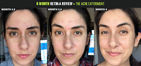 Retin-A Before/After :: The Acne Experiment