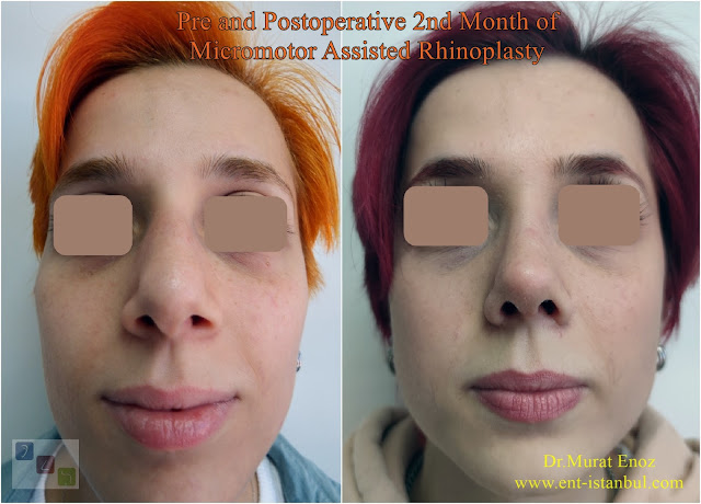 Before and After 2 Months of Rhinoplasty, Postoperative 2nd Month of Nose Job, Before and After Female Nose Aesthetic Surgery
