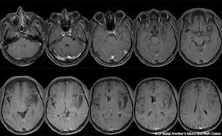 MEDIAL%2BTEMPORAL%2BCVT.jpg