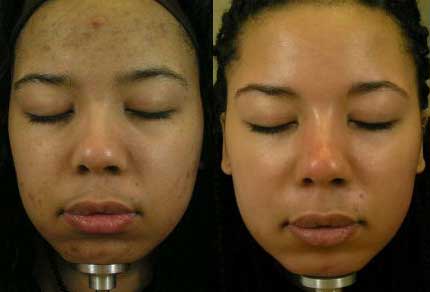 Skin lightening cream melasma uk ~ Skin Whitening Plus