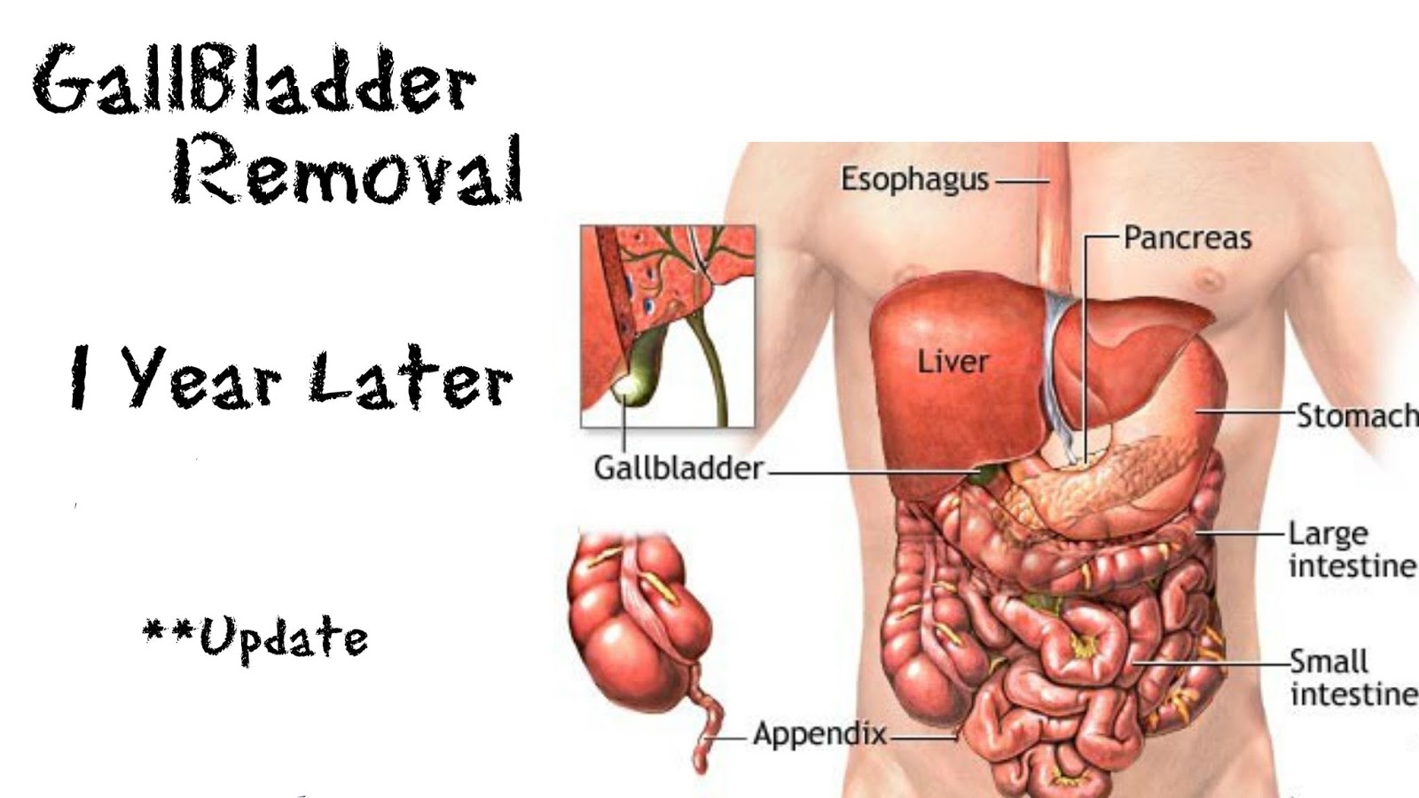what type of diet after gallbladder removal