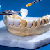 Ưu điểm của răng sứ cercon là gì?