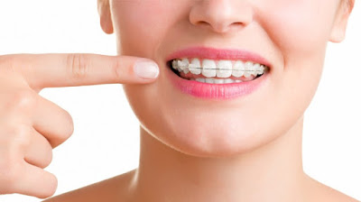 Chia sẻ quy trình niềng răng lệch lạc tại nha khoa