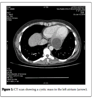 Multi-Organ Hydatidosis Involvement