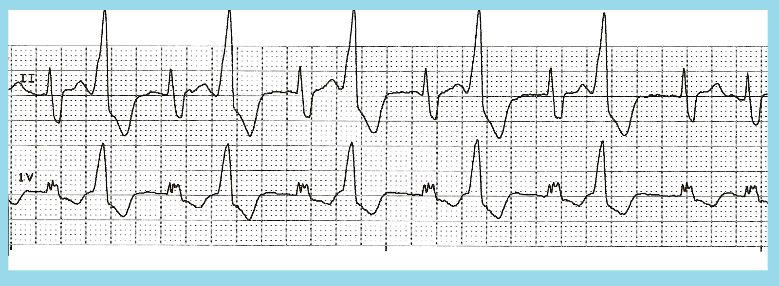 Float Nurse Various Bigeminal Pvcs