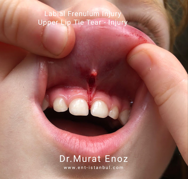 Labial Frenulum Injury upper lip tie tear