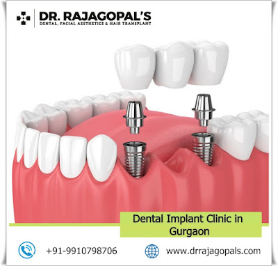 Dental implants in Gurgaon, Dental implant treatment in Gurgaon