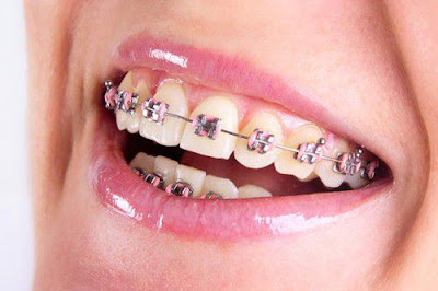  Làm thế nào để răng đều và đẹp? 