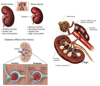 Cure For Diabetes Type 1 2010 : What Causes Oteomyelitis Of Bone