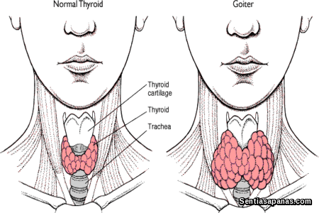 Penyakit Tiroid